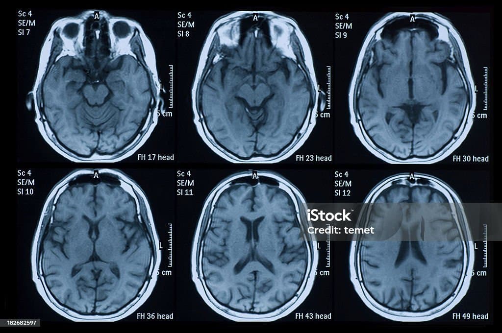 Dementia Brain MRI Generation using Conditional DCGAN